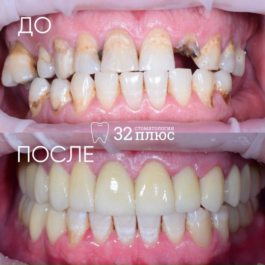 Тотальное восстановление здоровья и эстетики зубов!