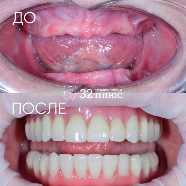 Пациентка обратилась в клинику с жалобами на недостаточную фиксацию и подвижность старого съёмного протеза на нижней челюсти во время еды.