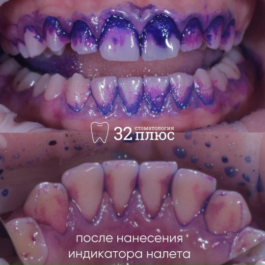 Пациент обратился на прием для профессиональной гигиены полости рта и с жалобами на кровоточивость десен.