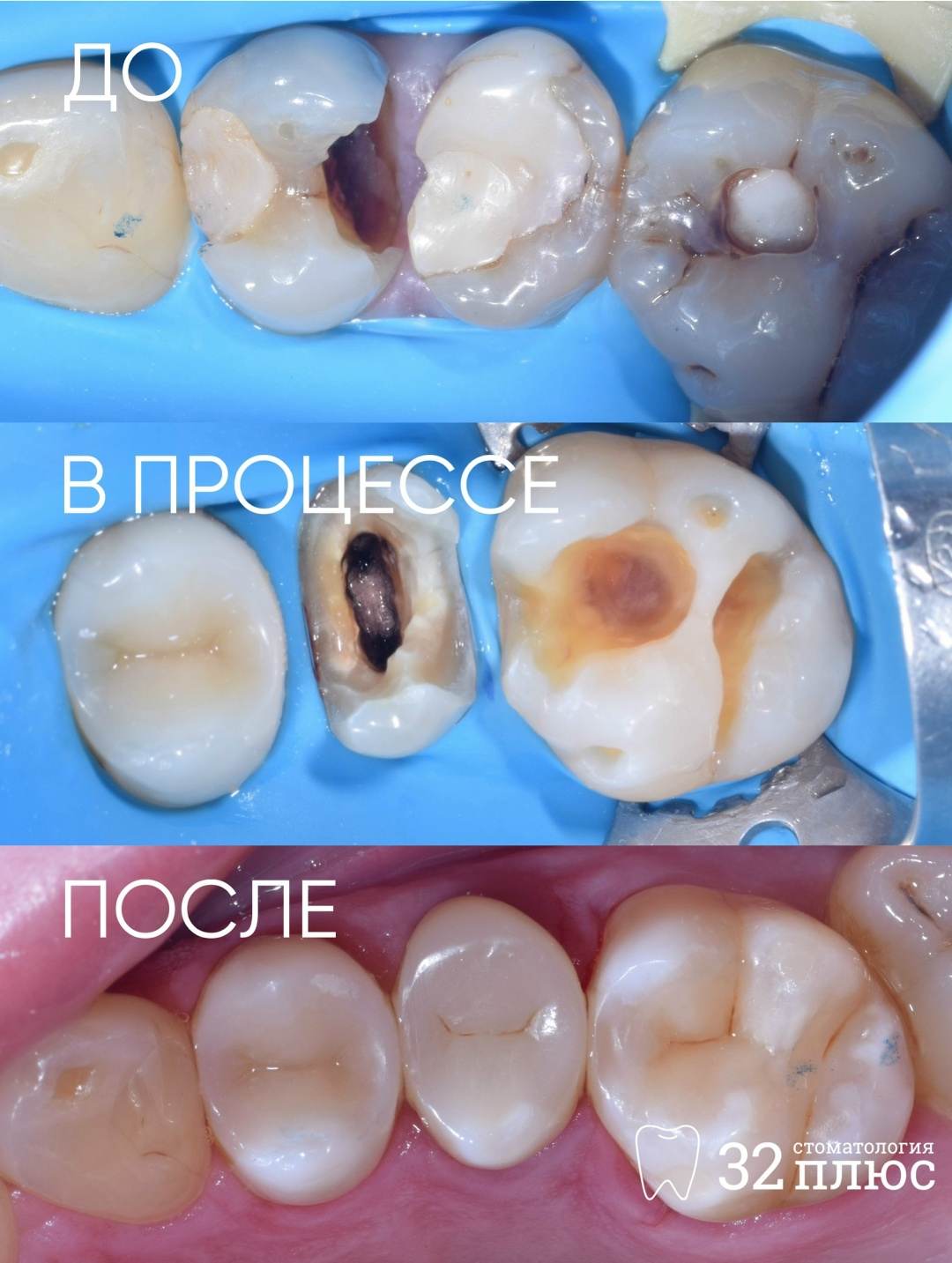 Как мы сохранили 3 разрушенных зуба, которые могли пойти на удаление.