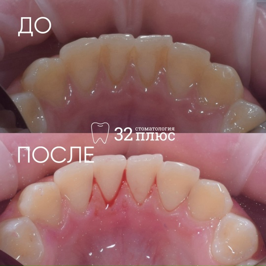 Пациент обратился на прием для профессиональной гигиены полости рта и с жалобами на кровоточивость десен.