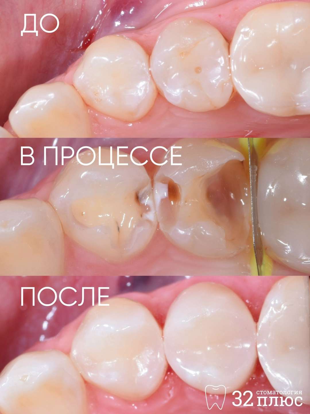 Ничего не болит, но кариес разрушает зуб