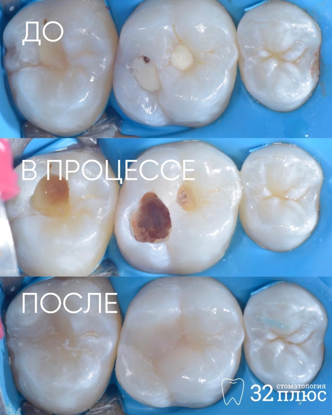 Клинический случай: кариес под старой пломбой