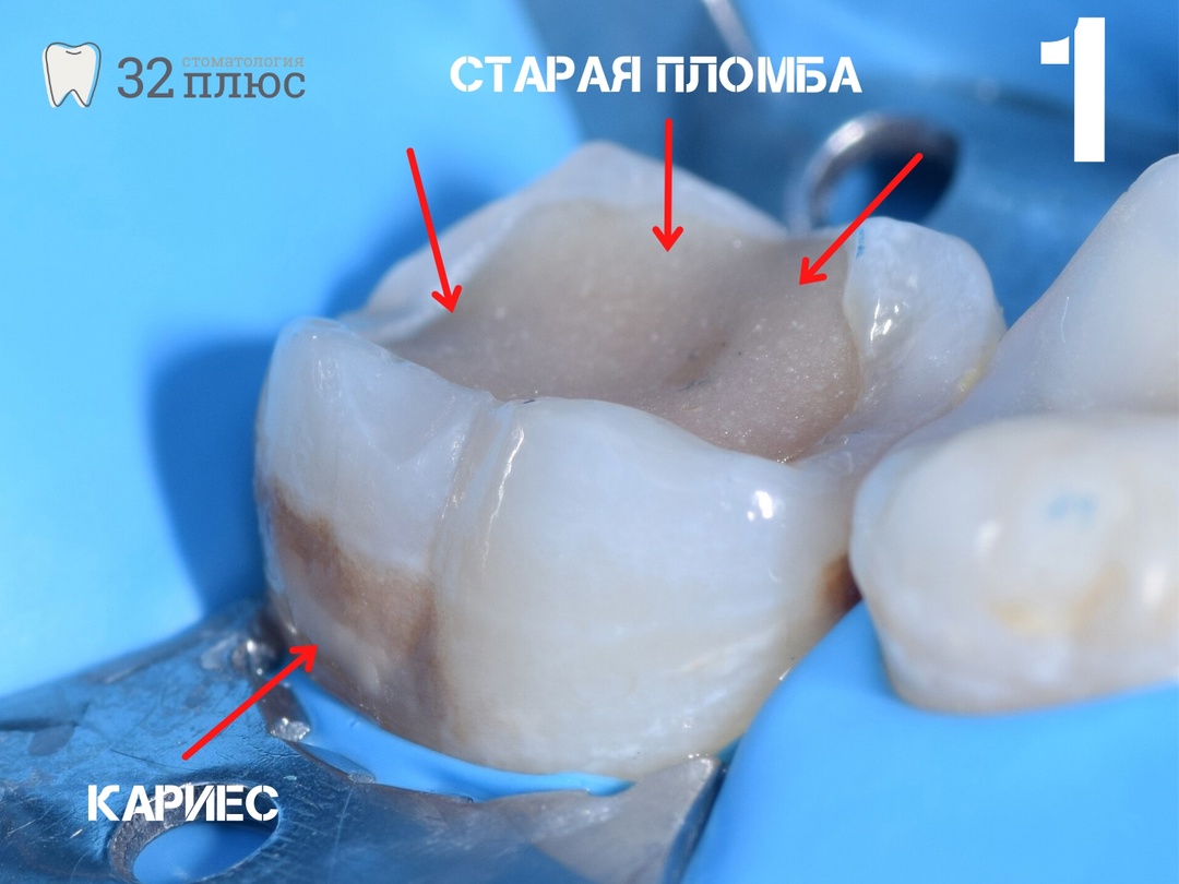 Клинический случай объёмного восстановления зуба.