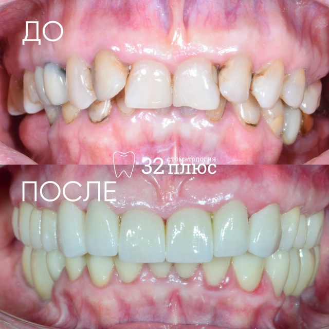 Полная реабилитация улыбки