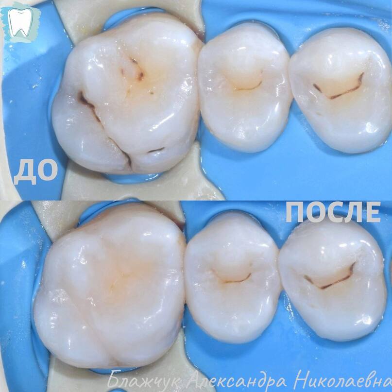 Результаты лечения кариеса зуба 26.