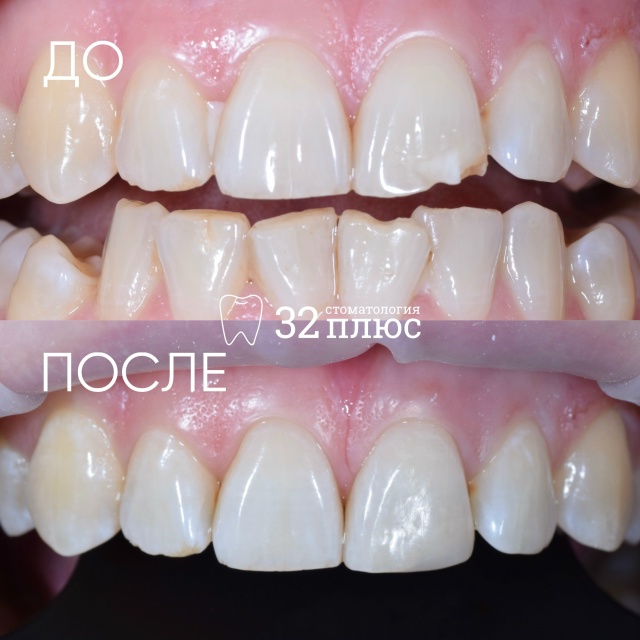 Эстетическая реставрация