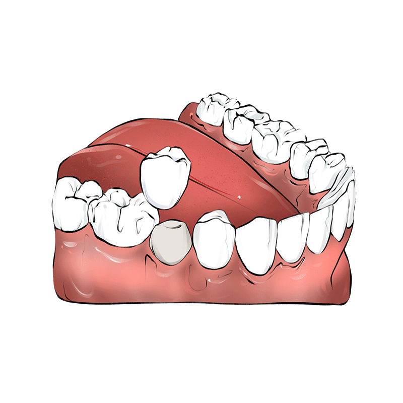 Лечение зубов коронками