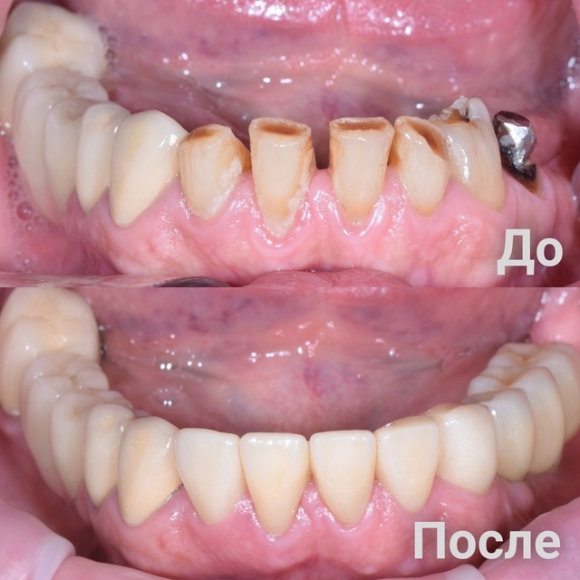 Восстановление анатомической формы зубов на нижней челюсти коронками из цельного диоксида циркония