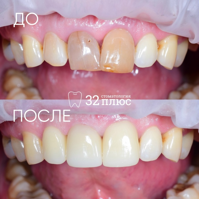 Зубы разных оттенков?