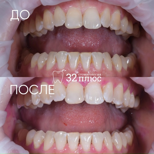 Пациент обратился в клинику с жалобами на образование зубного камня.