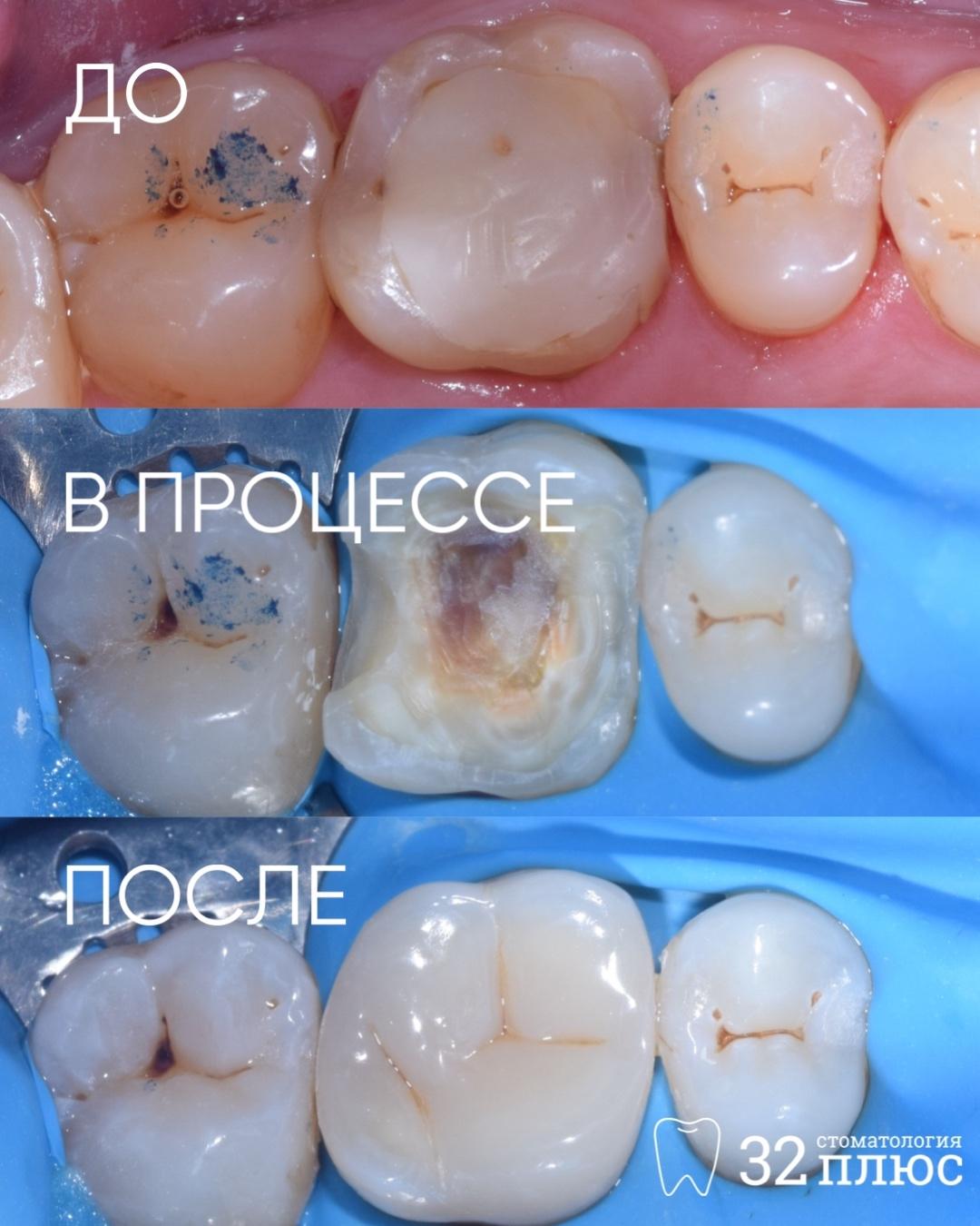 Как не должна выглядеть пломба: