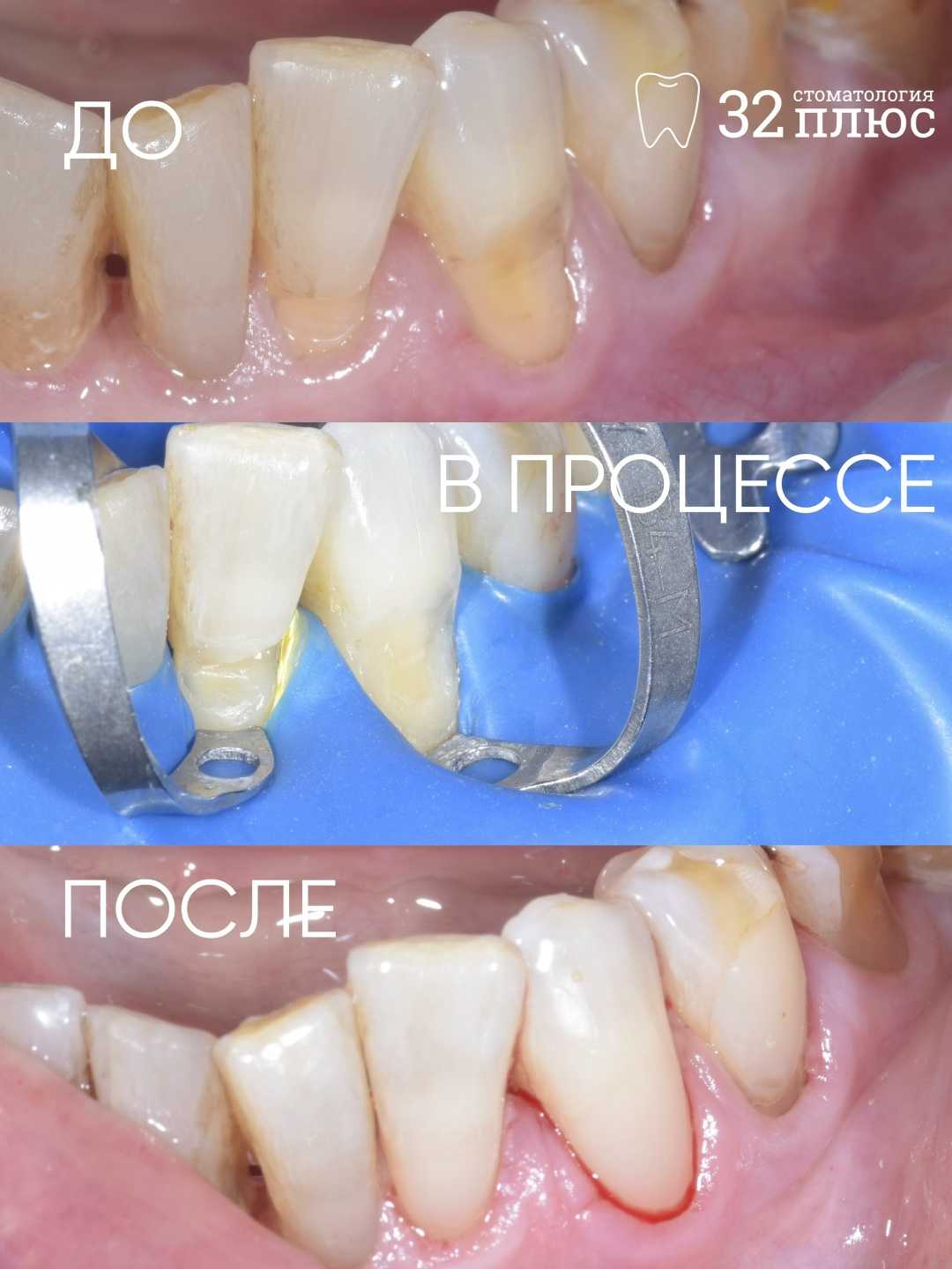 Что делать, если у десны появилась «выемка»?