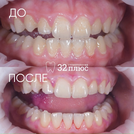 Пациент обратился на прием для профессиональной гигиены полости рта и с жалобами на кровоточивость десен.