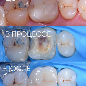 Как не должна выглядеть пломба: