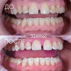 Кровоточивость дёсен при чистке зубов, постоянное воспаление и оголение корней зубов