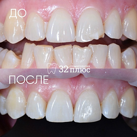 Эстетическая реставрация