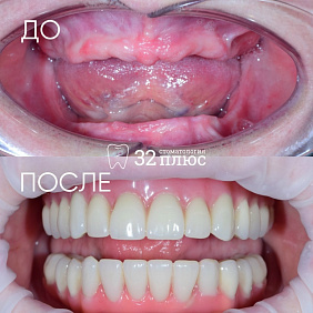 Пациентка обратилась в клинику с жалобами на недостаточную фиксацию и подвижность старого съёмного протеза на нижней челюсти во время еды.