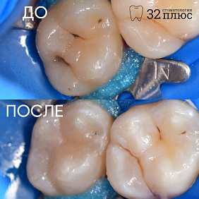 Пациент находится на этапе санации полости рта.