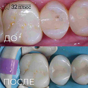 На первый взгляд кажется, что кариес отсутствует, но после препарирования открывается полная картина.