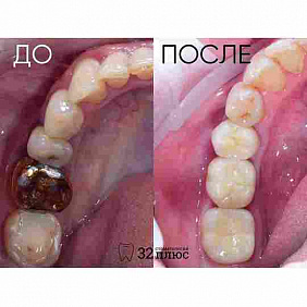 Восстановление жевательного сегмента нижней челюсти.