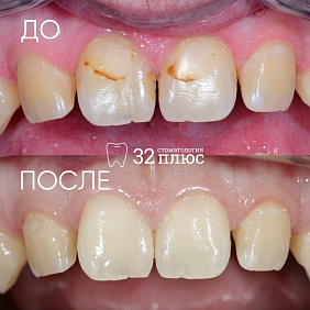 Иногда даже небольшие пломбы на передних зубах могут менять улыбку
