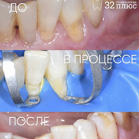 Что делать, если у десны появилась «выемка»?