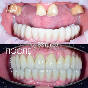 Тотальная реабилитация верхней и нижней челюстей.