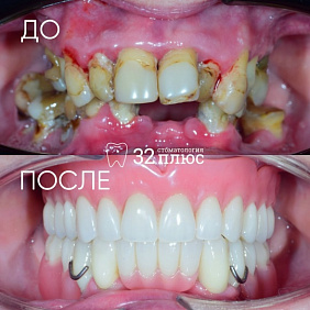 В нашей клинике мы подбираем план лечения так, чтобы пациент получил лучший результат в рамках своих возможностей!