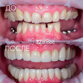 Когда улыбка требует комплексного решения