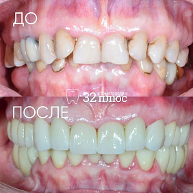 Полная реабилитация улыбки