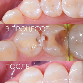 Ничего не болит, но кариес разрушает зуб