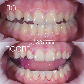 Пациент обратился на прием для профессиональной гигиены полости рта и с жалобами на кровоточивость десен.