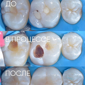 Клинический случай: кариес под старой пломбой