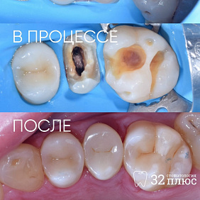 Как мы сохранили 3 разрушенных зуба, которые могли пойти на удаление.