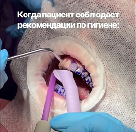 Пациентка была на повторной профгигиене и мы смогли увидеть, что все рекомендации по домашнему уходу выполняются на ура