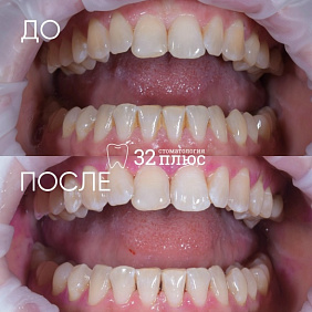 Пациент обратился в клинику с жалобами на образование зубного камня.