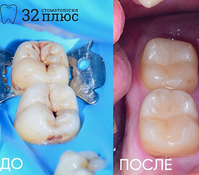 Наглядный пример, как глубоко может распространиться кариес