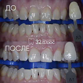 Результат профессионального отбеливания