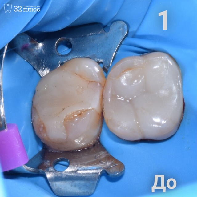 Представляем Вашему вниманию восстановление зуба под коронку стоматолога-терапевта Блажчук Александры Николаевны