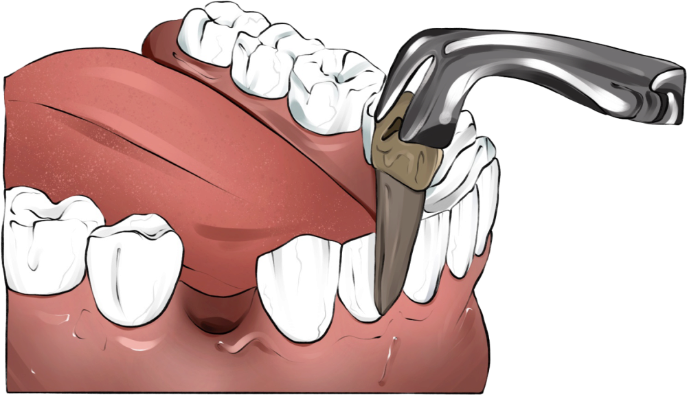 Удаление зуба проходит за один визит и занимает порядка 30 минут