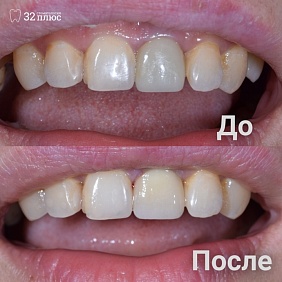 Пациентка обратилась в клинику с жалобой на несоответствие цвета коронки переднего зуба цвету своего зуба.