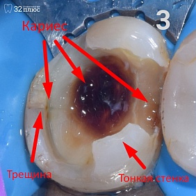 Представляем Вашему вниманию восстановление зуба под коронку стоматолога-терапевта Блажчук Александры Николаевны